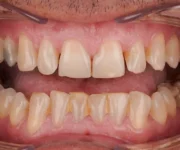 Alanya’da E-max Lamine tedavisi ile doğal ve estetik bir gülüşe kavuşun. En iyi klinikleri Best of Alanya ile keşfedin!