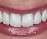 alanya diş kliniği, zirkonyum kron alanya, estetik diş kaplama, gülüş tasarımı, alanya zirkonyum kaplama, alanya diş estetiği, best of alanya, zirkonyum fiyatları, diş kaplama alanya, alanya dental turizm