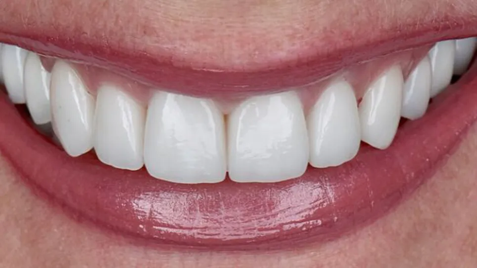 alanya diş kliniği, zirkonyum kron alanya, estetik diş kaplama, gülüş tasarımı, alanya zirkonyum kaplama, alanya diş estetiği, best of alanya, zirkonyum fiyatları, diş kaplama alanya, alanya dental turizm