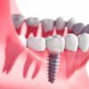 “Alanya’da implant uygulaması yapılan modern diş muayenehanesi ve dental ekipmanlar.”