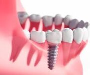 “Alanya’da implant uygulaması yapılan modern diş muayenehanesi ve dental ekipmanlar.”