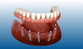 Moderne Zahnarztklinik in Alanya, in der fortschrittliche digitale Technologien für Implantatplanung und Zahnbehandlung im Jahr 2026 eingesetzt werden.