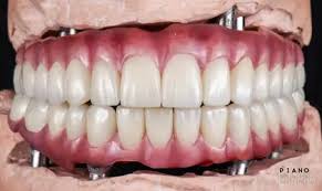 Moderne Zahnarztklinik in Alanya mit internationalen Patienten, die eine Implantatbehandlung im Rahmen des Gesundheitstourismus erhalten.