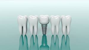 The Latest Innovations in Dental and Implant Treatments in Alanya for 2026