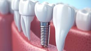 Alanya’daki modern diş kliniğinde yapay zeka destekli yazılım kullanılarak implant tedavisi planlanıyor ve analiz ediliyor.