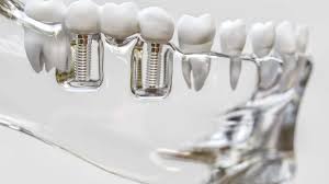 Alanya tarjoaa useita etuja implanttihoidossa verrattuna Suomeen, erityisesti hinnan ja nopeuden osalta.