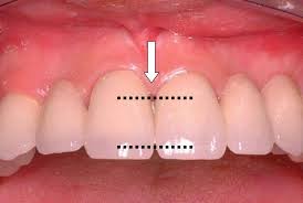 Alanyassa hammashoitoa voidaan yhdistää lomaan, kun taas Suomessa hoito painottuu arkeen ja kotimaiseen järjestelmään.