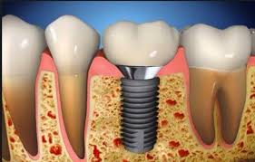 Kallista Suomessa, edullista Alanyassa – suuri ero implanttihoidoissa