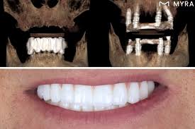 Moderne Zahnarztklinik in Alanya, in der ein Patient eine schmerzfreie und schnelle Implantatbehandlung mit lokaler Betäubung erhält.