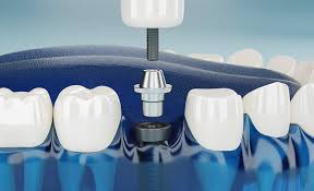 Implantit samana päivänä – uuden sukupolven hoidot Alanyassa