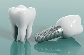 Alanyan hammasklinikalla käytetään tekoälypohjaiset ohjelmistoa hammasimplanttien suunnittelussa ja hoitoprosessin optimoinnissa.