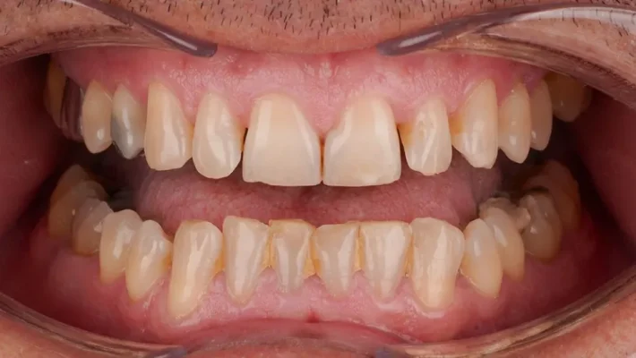 Alanya’da E-max Lamine tedavisi ile doğal ve estetik bir gülüşe kavuşun. En iyi klinikleri Best of Alanya ile keşfedin!