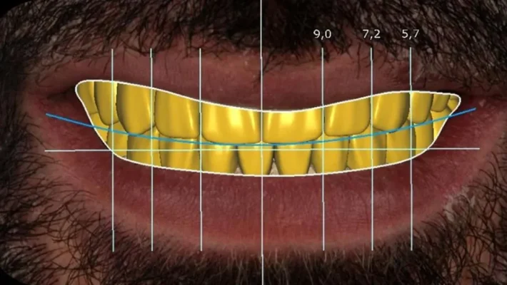 alanya diş kliniği, dijital gülüş tasarımı, gülüş estetiği alanya, alanya gülüş tasarımı yapan klinikler, estetik diş tedavisi, smile design alanya, yüz uyumlu gülüş, alanya diş hekimi, best of alanya, dijital estetik planlama