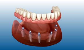 Moderne Zahnarztklinik in Alanya, in der fortschrittliche digitale Technologien für Implantatplanung und Zahnbehandlung im Jahr 2026 eingesetzt werden.