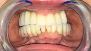 Modern dental clinic in Alanya treating international patients with advanced implant technology as part of health tourism services.