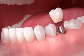 Modern dental clinic in Alanya where a patient receives a same-day dental implant using advanced digital planning and surgical technology.