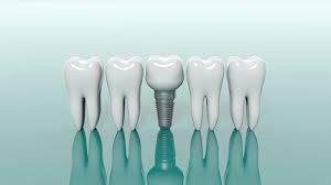 The Latest Innovations in Dental and Implant Treatments in Alanya for 2026