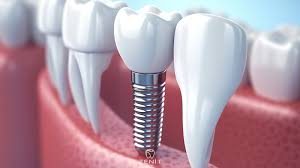 Alanya’daki modern diş kliniğinde yapay zeka destekli yazılım kullanılarak implant tedavisi planlanıyor ve analiz ediliyor.