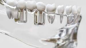 Alanya tarjoaa useita etuja implanttihoidossa verrattuna Suomeen, erityisesti hinnan ja nopeuden osalta.