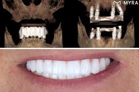 Moderne Zahnarztklinik in Alanya, in der ein Patient eine schmerzfreie und schnelle Implantatbehandlung mit lokaler Betäubung erhält.