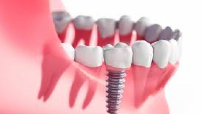 “Alanya’da implant uygulaması yapılan modern diş muayenehanesi ve dental ekipmanlar.”