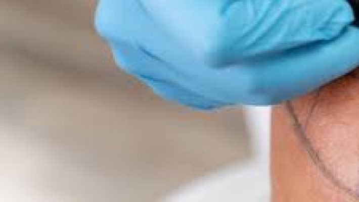 “Alanya MEDITURN Hair Transplant Center’da profesyonel saç ekimi ve medikal estetik hizmetleri”