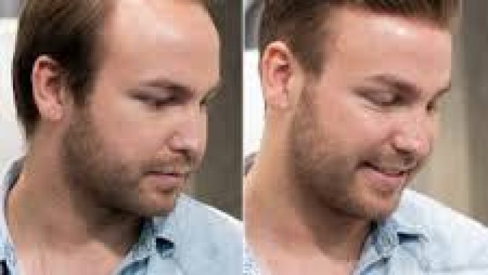 “Alanya Saç Ekimi ve Protez Saç Merkezi’nde profesyonel saç ekimi ve protez saç çözümleri”